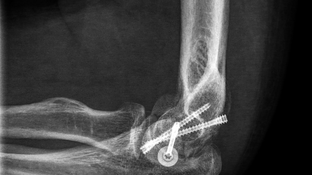 recomposición húmero distal